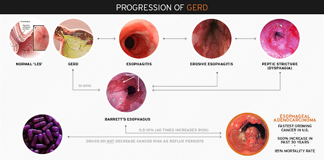 Gerd simptom 4 Stages