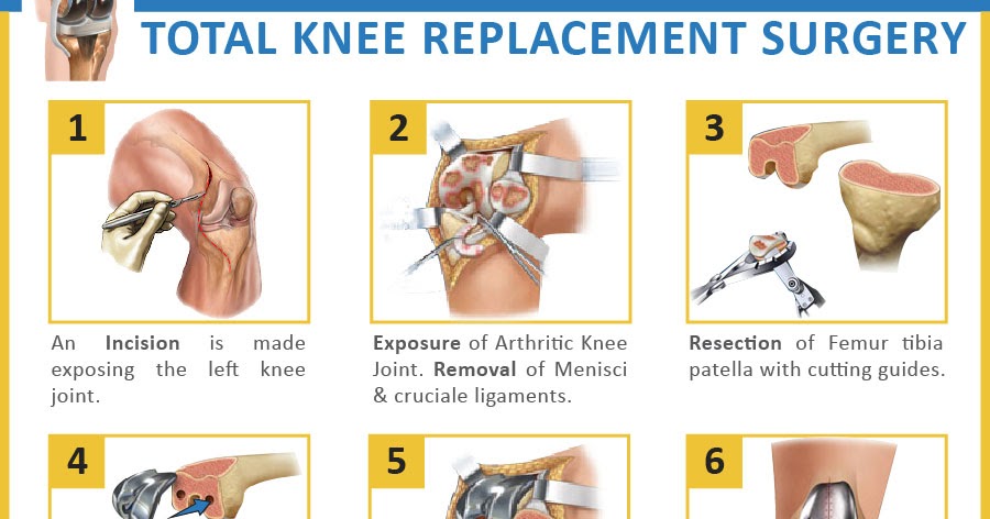 Knee Cap Replacement After Total Knee Replacement Doctorvisit
