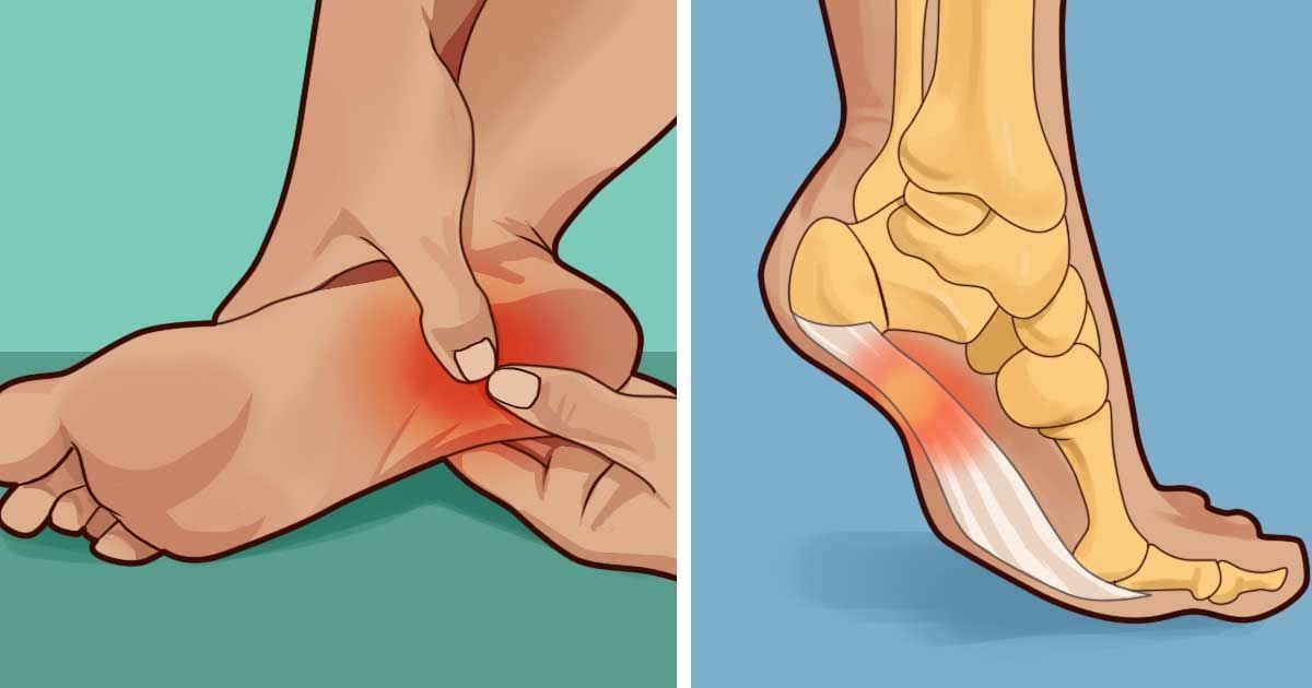 How to treat and prevent plantar fasciitis at home small