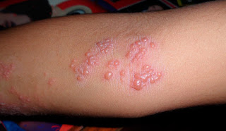 Con Que Se Cura El Herpes Con Que Se Cura El Herpes