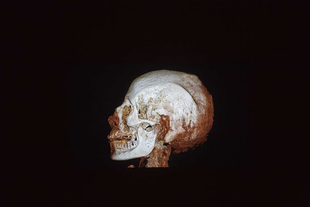 Israel to display ancient mummy with modern-day afflictions Israel to display ancient mummy with modern-day afflictions