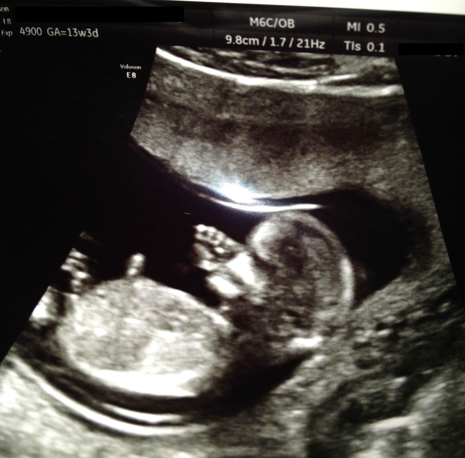 Фото ребенка 13 недель. УЗИ 13 недель беременности. УЗИ 12-13 недель беременности. Снимок УЗИ на 13 неделе беременности.