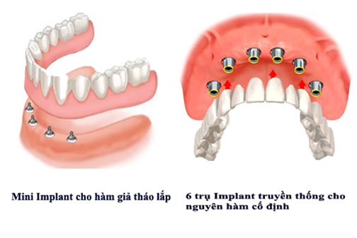 NHỮNG ĐIỀU CẦN BIẾT VỀ CẤY GHÉP MINI IMPLANT