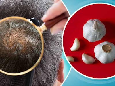 Does Raw Garlic Promote Hair Growth? Does Raw Garlic Promote Hair Growth?