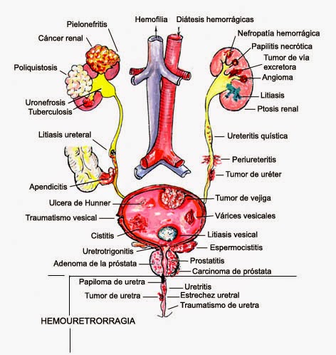 hematuria en cáncer de próstata