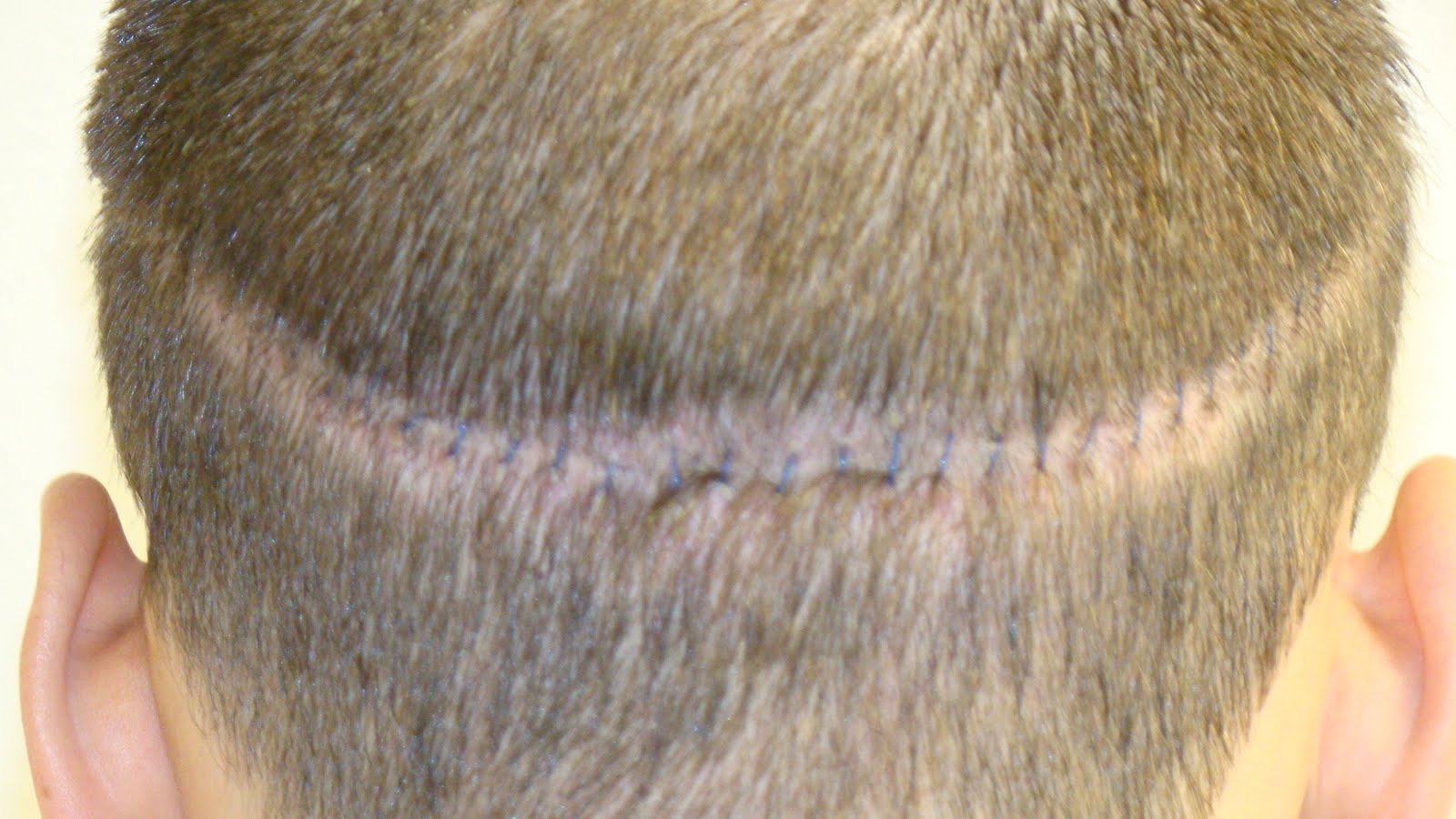 Hair Transplant Healing Time (Ten Days Later) Dr. Brett Bolton Blog