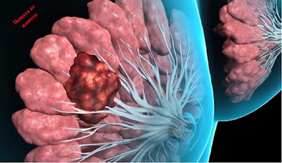 Симптоми и лечение на мастопатия