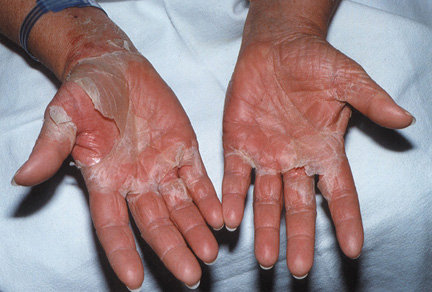 Rash On Hands Feet And Hip Child Kawasaki Disease Rash On Hands Feet And Hip Child Kawasaki Disease