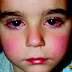 Nόσος ή σύνδρομο Kawasaki, σε παιδιά, με υψηλό πυρετό, επιπεφυκίτιδα, εξάνθημα, πρησμένα χέρια, διάρροια  