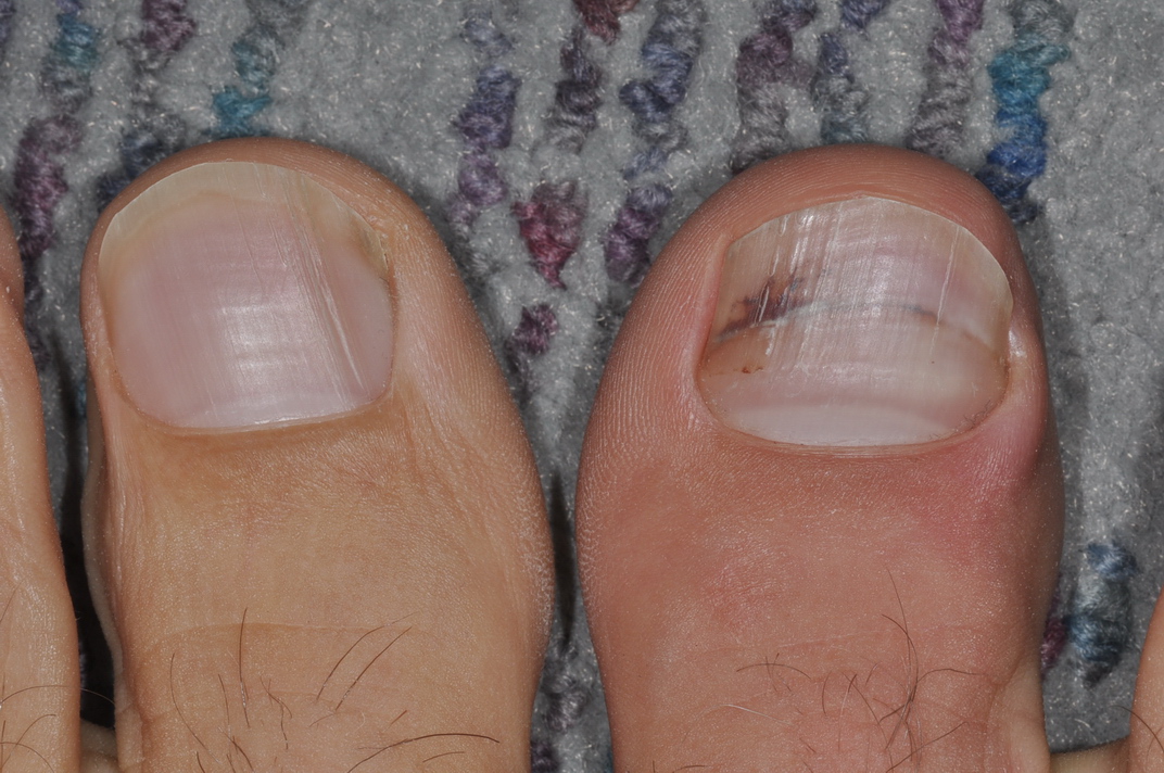 Black Spot On Toenail Near Cuticle Nail Ftempo