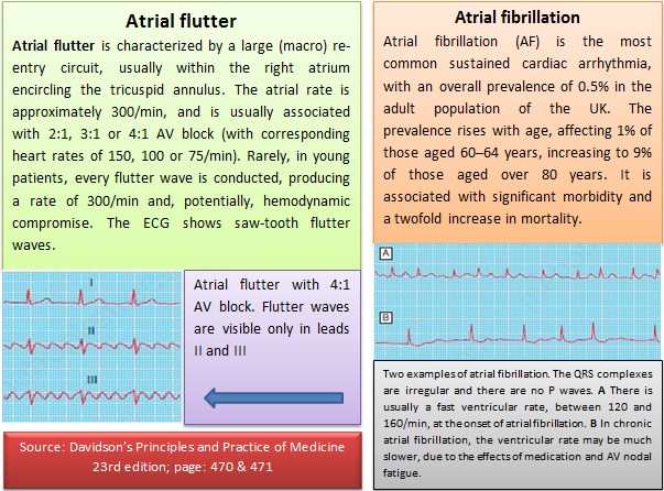 Atrial Flutter Causes Atrial Flutter Symptoms Causes Diagnosis With Images