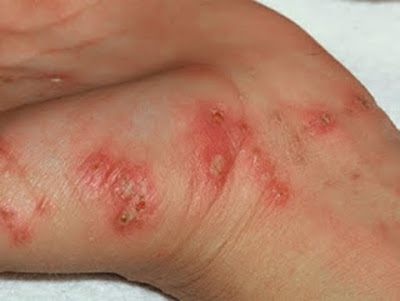 Bệnh ghẻ Bệnh ghẻ
