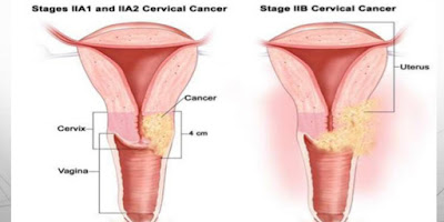 ung thư cổ tử cung giai đoạn 2