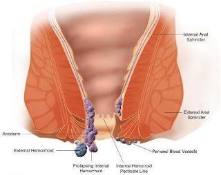 Obat Benjolan Di Anus Dan Keluar Darah Obat Benjolan Di Anus Dan Keluar Darah