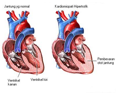 hipertenzije, kardiomiopatija)