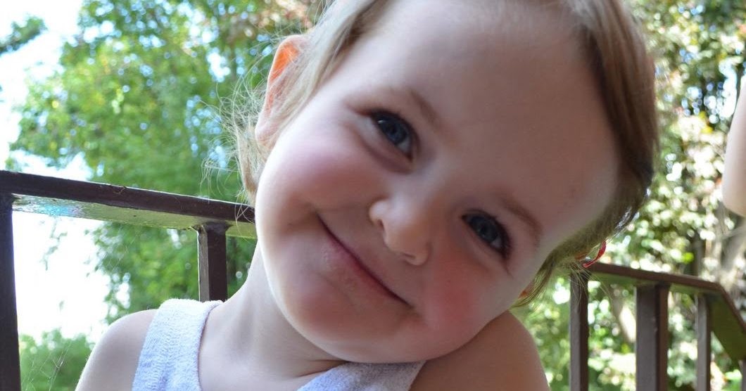 Beals Hecht Syndrome Images, Life, Expectancy, Symptoms, Causes