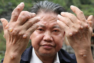 Menyembuhkan Kutil Kemaluan, Benjolan Kutil di Kemaluan, Cara Alami Mengobati Benjolan Kutil di Alat Vital