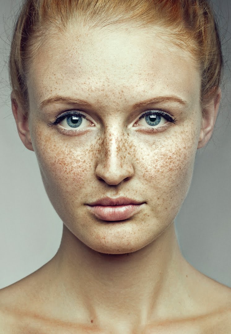 Freckles Facial 77