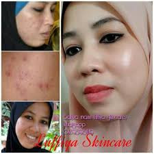 paket acne drw skincare