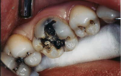 Nguyên nhân răng bị sâu ăn mòn