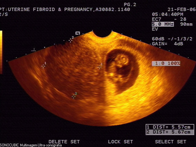 Матка 6 7 недель. Миома и беременность на УЗИ. Миома матки и беременность УЗИ.