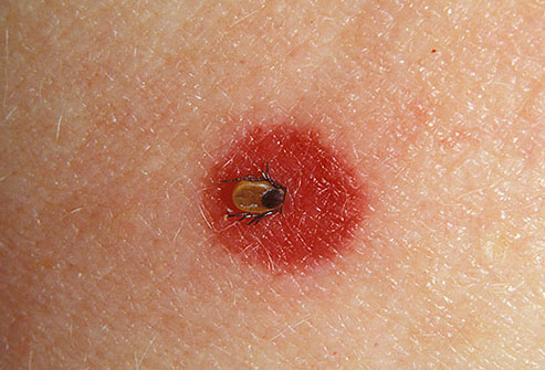 flea bite rashes - Top Doctor Insights on HealthTap