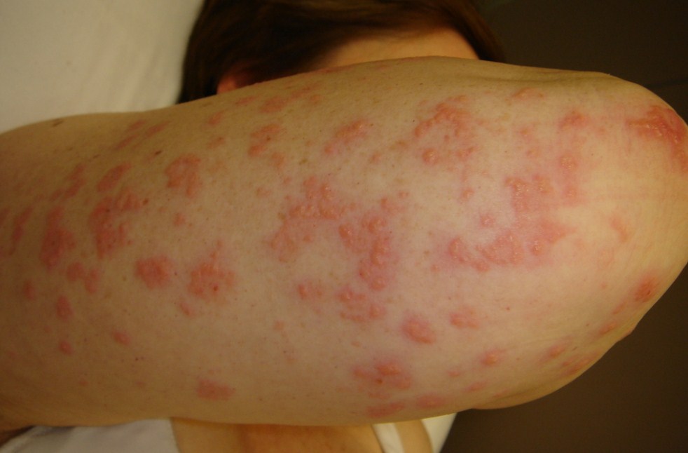 Dermatitis Herpetiformis Gejala, Penyebab, Dan Cara Mengatasi Yang