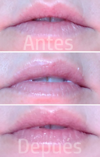antes despues voluminizador revox Revox rellenar labios antes después