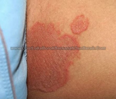 Obat Untuk Gatal-Gatal Di Selangkangan Paha Terampuh Obat Untuk Gatal-Gatal Di Selangkangan Paha Terampuh
