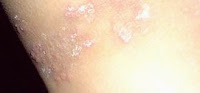 Obat yang Paling Ampuh untuk Penyakit Kulit Eksim Obat yang Paling Ampuh untuk Penyakit Kulit Eksim