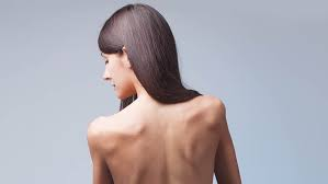 3 maiores causas e sintomas da Anorexia Nervosa