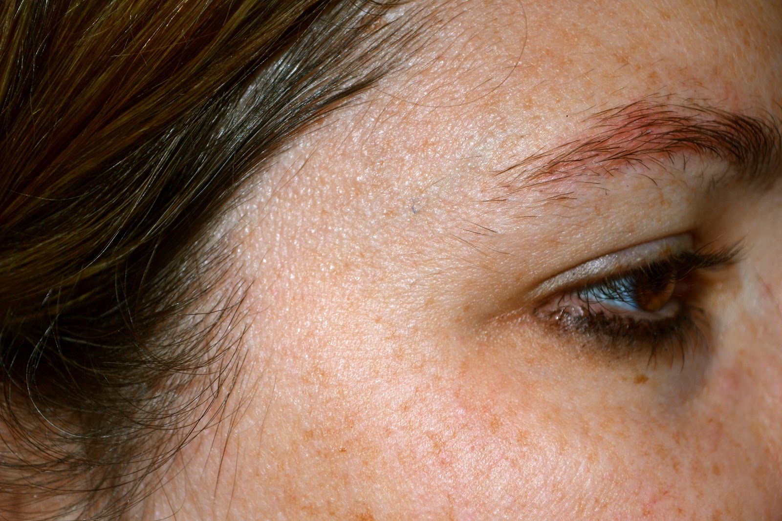 Dry Patches Under Eyebrows