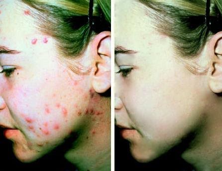 Acnetreatment: Acne Vulgaris - What do you know about this skin disease