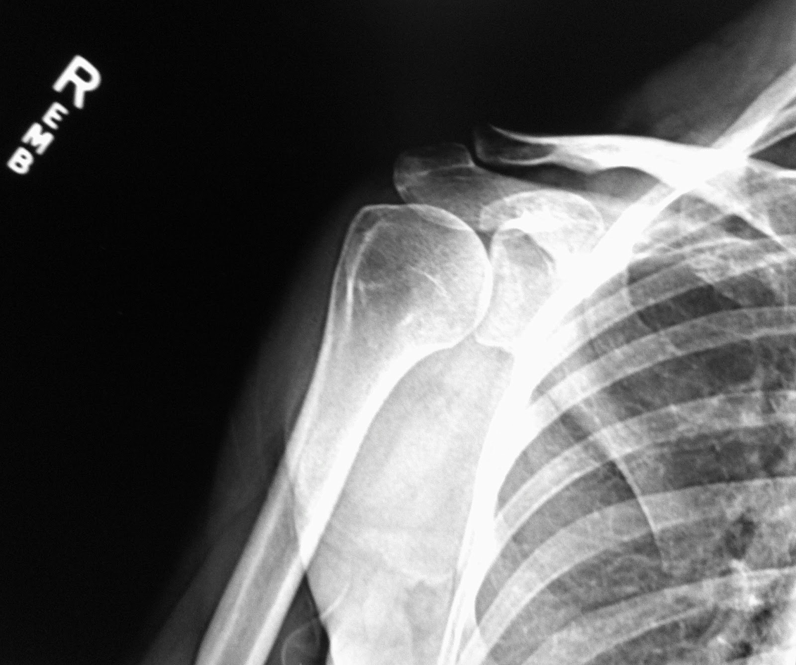 Adhesive Capsulitis Alternative Approach Radiographs for Adhesive