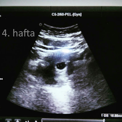 4 haftalık gebelik görüntüsü