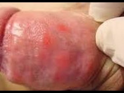 Obat Buat Penyakit Kencing Nanah