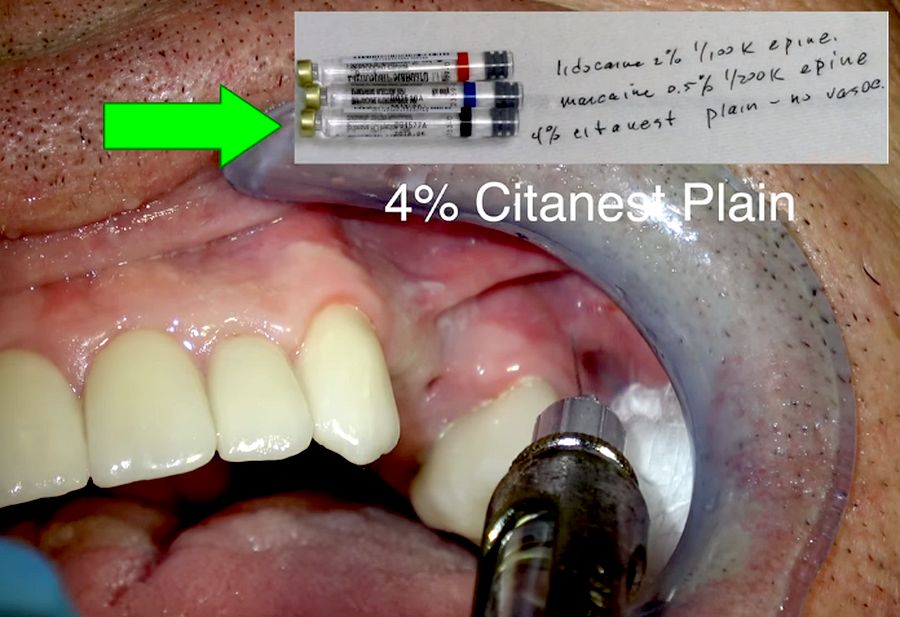 DENTAL ANESTHESIA How to Give a Painless Injection Steven T