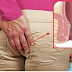 Effective Way On How To Remove Hemorrhoids Naturally