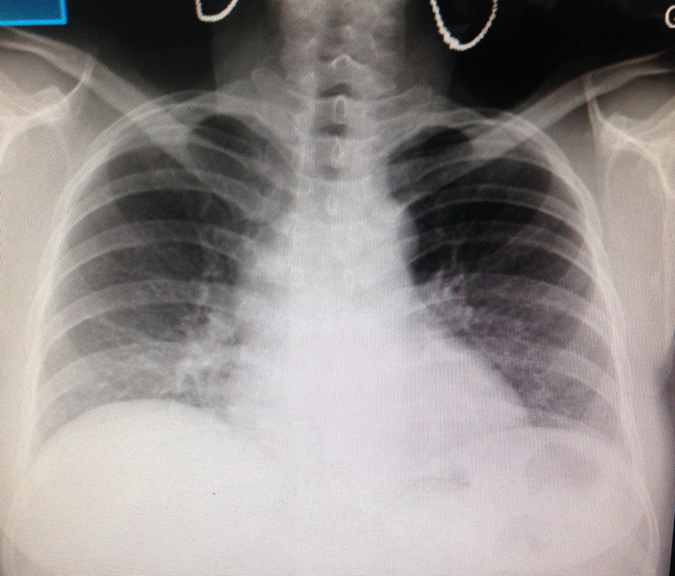 VIETNAMESE MEDIC ULTRASOUND CASE 448 FEVER and ASCITES, Dr PHAN