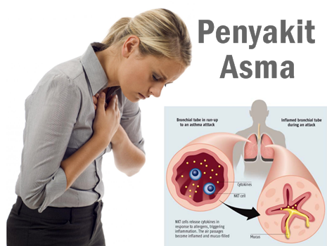 Cara Cepat Mengobati Penyakit Asma Cara Cepat Mengobati Penyakit Asma