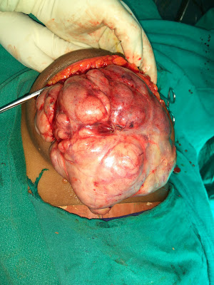 Phyllodes Tumor Phyllodes Tumor