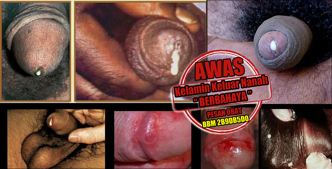Beli Obat Herbal untuk Penyakit Kencing Nanah Beli Obat Herbal untuk Penyakit Kencing Nanah