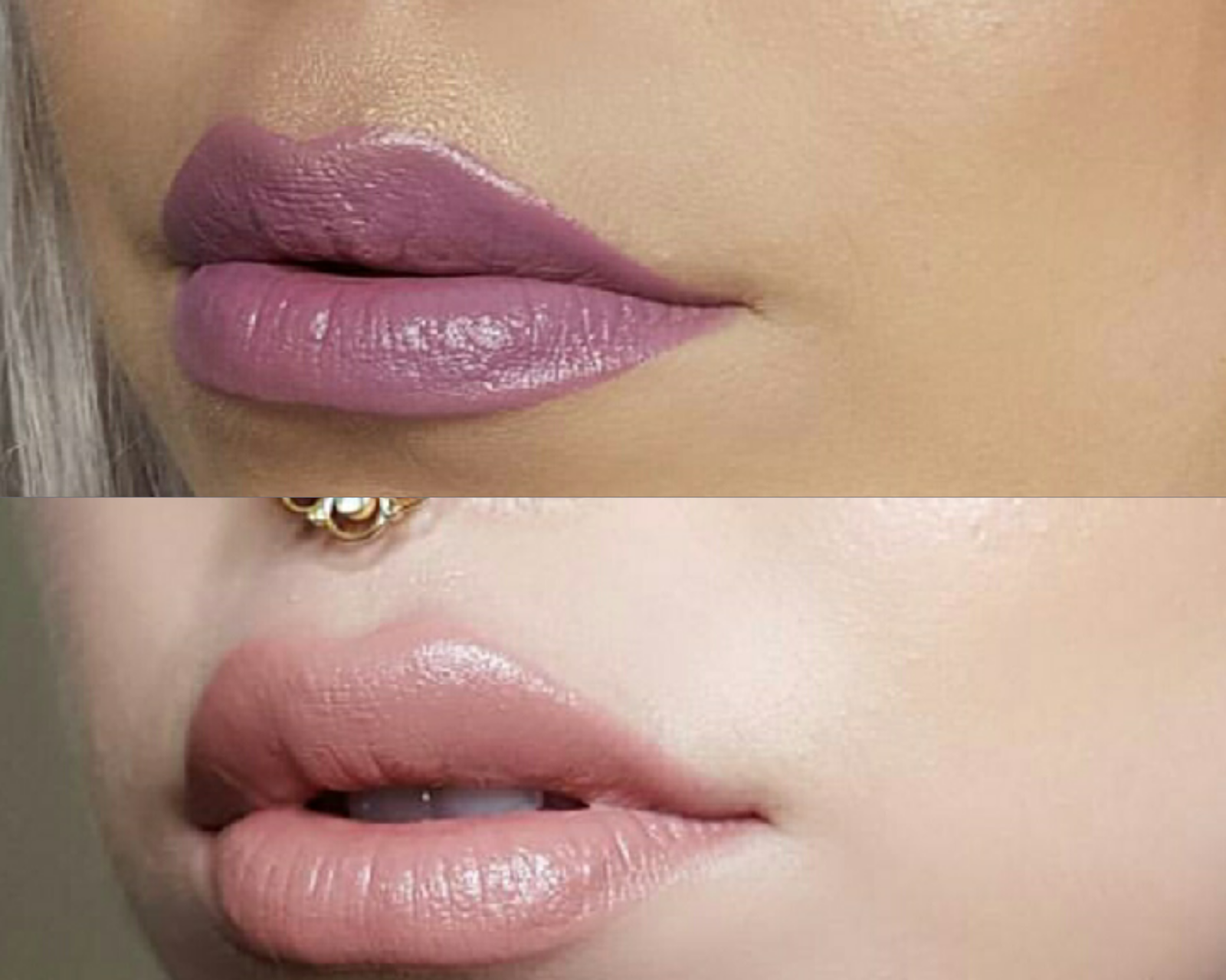 Dupethat Flawless Laser Center Lip Filler Review & Experience