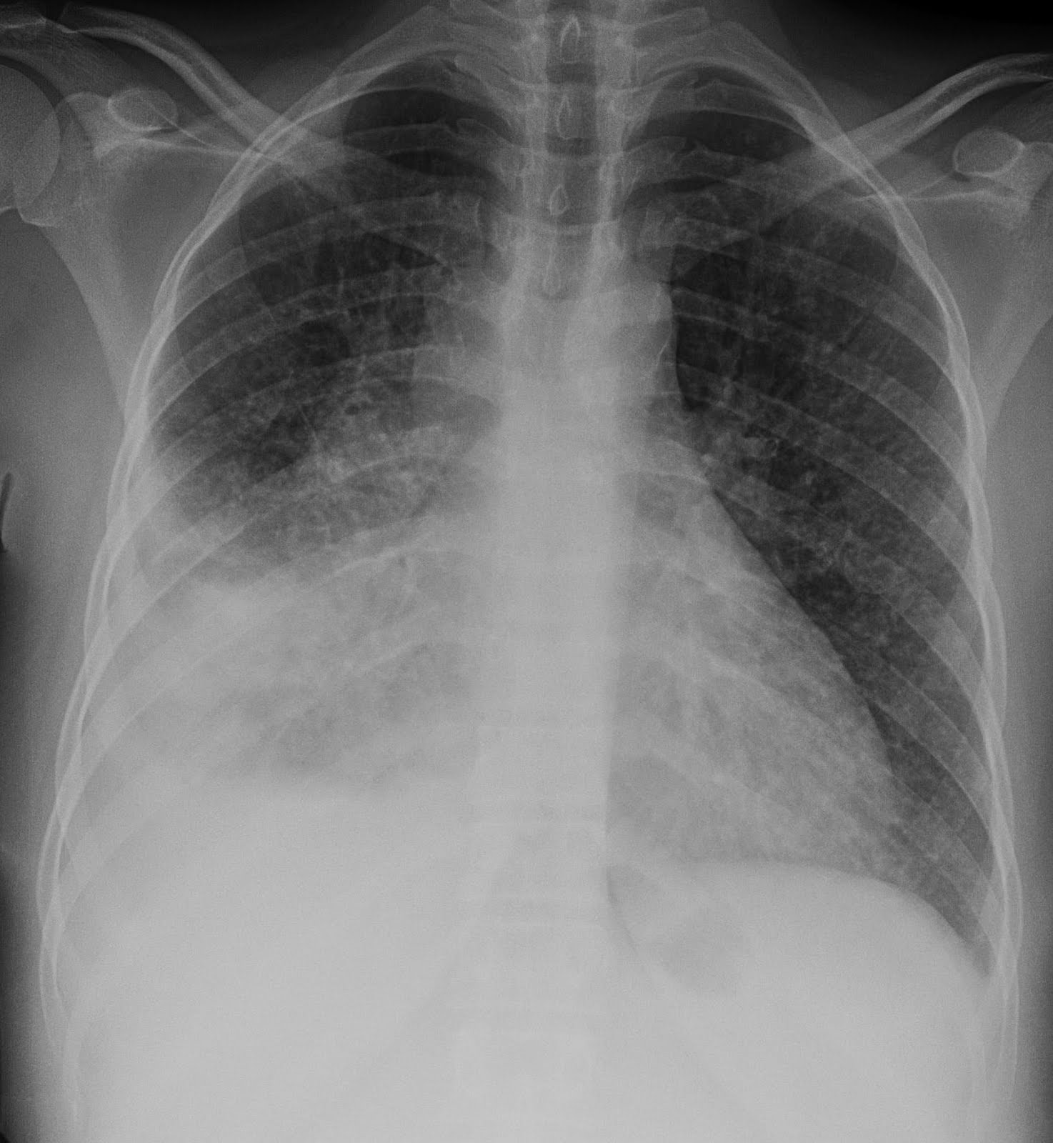 Reproductive Health And Fetal Tuberculosis TB 