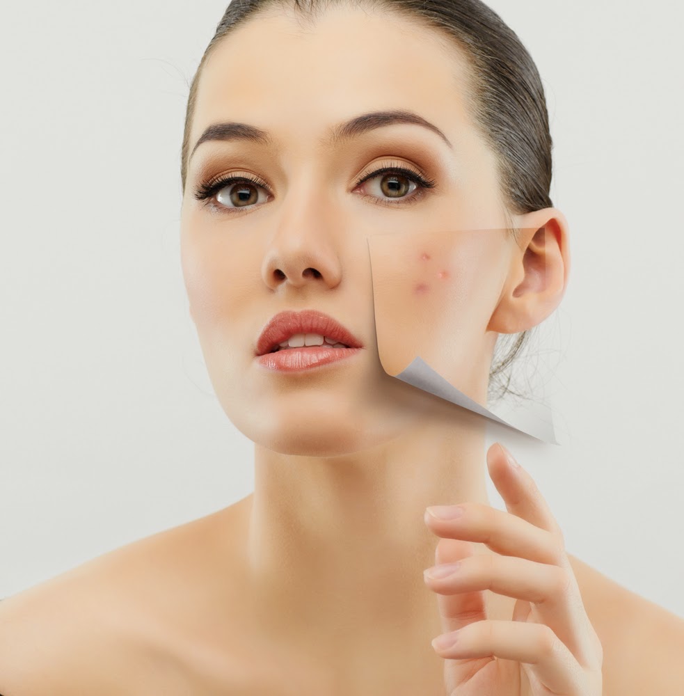 Resultado de imagen para ACNE