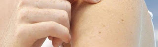 “11 شامة “على جلد يدك مؤشر على الأصابة بسرطان الجلد 