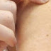 “11 شامة “على جلد يدك مؤشر على الأصابة بسرطان الجلد 