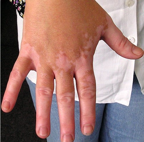 Pengobatan Penyakit Vitiligo (Penyebab, Gejala, Pantangan & Anjurannya) Pengobatan Penyakit Vitiligo (Penyebab, Gejala, Pantangan & Anjurannya)
