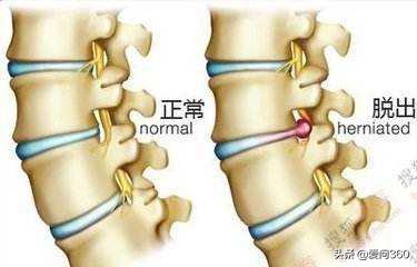 腰間盤突出會讓腰部疼痛，這幾個穴位多按按，減輕你的疼痛(腰痛、腰酸)