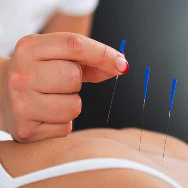 Akupunktur, Manfaat Akupunktur, Manfaat Terapi Akupunktur